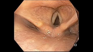 EGD  Step 1  Hypopharynx screening [upl. by Suiravaj376]