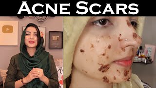 Remove Acne Scars گڑھے Get Smooth Even Skin with Easy Home Remedy [upl. by Ayn23]