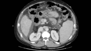 portal enteropathy [upl. by Deonne]