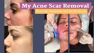 My Acne Scar Removal Journey RF Microneedling with PRP Treatments and Results [upl. by Rosemarie]