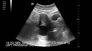 Left Lower Quadrant Abdominal Pain 810 in 13 yo Girl [upl. by Aurie]