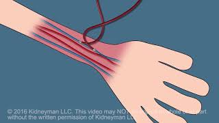 Dialysis Fistula animation [upl. by Larrabee]