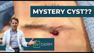 Mystery Cyst  Dr Derm [upl. by Tomlin]