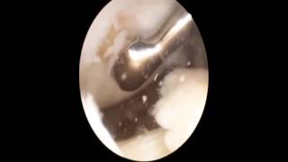 Microfracture arthroscopic knee surgery [upl. by Itsuj]