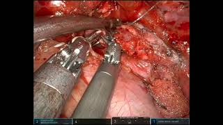 URATS left main bronchus sleeve resection and second carinal reconstruction for carcinoid tumor [upl. by Alleris]