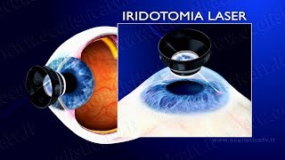 Glaucoma ad angolo chiuso e glaucoma acuto terapia con iridotomia laser wwwoculisticaTVit [upl. by Consalve]