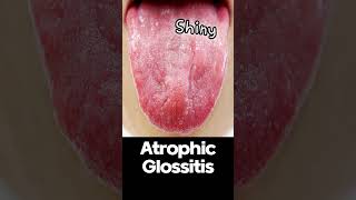 Atrophic Glossitis  Symptoms and Causes shorts [upl. by Fesoy650]