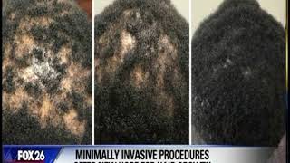 Arlington Hair Loss Specialist Talks Hair ReGrowth Options 6823208443  FOX 26 Houston Segment [upl. by Arrak]