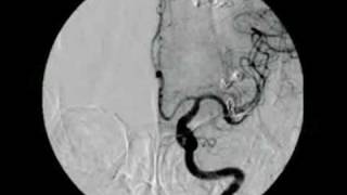 BRAIN ANEURYSM  ANEURISMA CEREBRAL 2 [upl. by Slemmer]