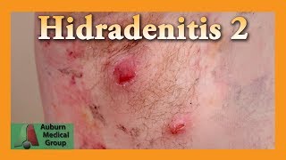 Hidradenitis Follow Up  Auburn Medical Group [upl. by Hpseoj]