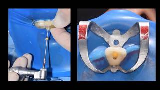 Guided endodontic access for root canal treatment for calcified Maxillary Central Incisor [upl. by Ihsoyim988]