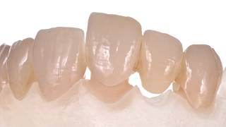 dentalABS  Celtra Press Passo a Passo [upl. by Standing]