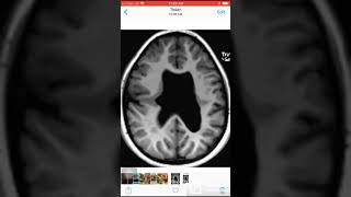 Case 036 Closed lip Schizencephaly and absent septum pellucidum [upl. by Ylsew]