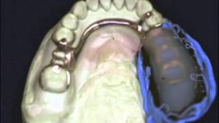 Altered Cast in Removable Partial Dentures [upl. by Oralla829]