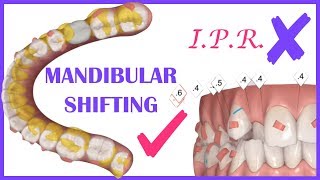 Orthodontics lecture on Invisalign clincheck  clear aligners and mandibular shifting [upl. by Esmerolda]