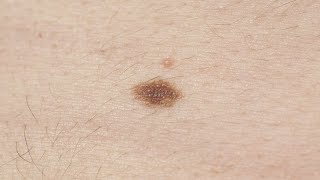 Melanoma symptoms How to spot signs and when to see a doctor [upl. by Saxon698]