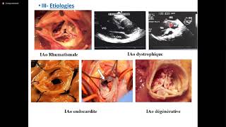 Insuffisance aortique [upl. by Mayer780]