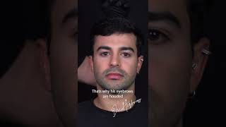 Endoscopic Forehead Brow and Cheek Lift Upper facelift 3Q Surgery By Dr Firas Hamdan [upl. by Nnairak]