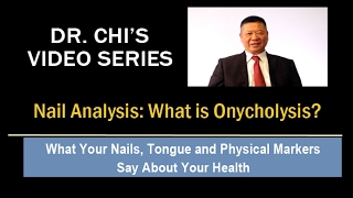 Dr Chis Fingernail and Tongue Analysis  Onycholysis [upl. by Gerty]