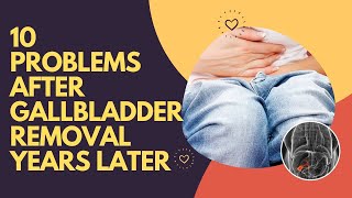 10 Problems After Gallbladder Removal Years Later  Post Gallbladder Surgery Issues [upl. by Auqenahc650]