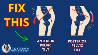 Anterior Pelvic Tilt Fix for Back Pain Relief  Exercise [upl. by Hi]