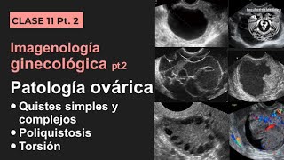 112  Imagenología de los ovarios Quistes simples y complejos poliquistosis y torsión [upl. by Annair]