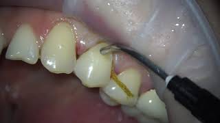 placing a filling on a tooth according to class 5  treatment of dental caries dentist teeth [upl. by Maice]