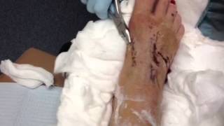 Lisfranc Dislocation Kwire removal [upl. by Llevrac921]