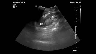 pleural fibrous tumor [upl. by Ennayehc402]