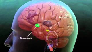 Deep Brain Stimulation explanation [upl. by Allrud]