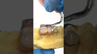 Adding a Crown for a Metal Clasped Partial lsk121shorts dentistry teeth [upl. by Odlabu]