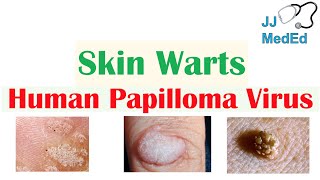 Overview of Skin Warts Verrucae  What Causes Them Who Gets Them  Subtypes and Treatment [upl. by Notsreik]