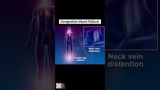 Congestive Heart Failure CHF  cardiology [upl. by Aiyekal370]