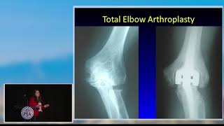 orthoPAc podcast episode 204  Elbow Arthritis and Arthroplasty Part 1 [upl. by Haiel251]