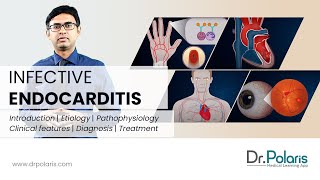 INFECTIVE ENDOCARDITIS  Etiology Pathophysiology Clinical Features Management  Animated [upl. by Rebeka]