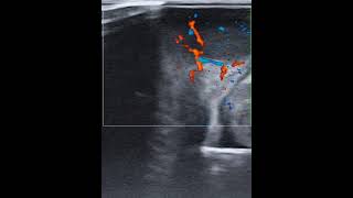 Color Doppler ultrasound of the tongue schwannoma in a 27yearold female [upl. by Sucitivel440]