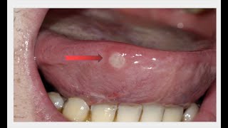 Tongue Ulcer Remedies treatment tonguecancer tonguecleaner ulcers cure care [upl. by Aniuqaoj389]