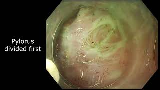 GPOEM for Gastroparesis Gastric Per Oral Endoscopic Myotomy [upl. by Eiramanin181]