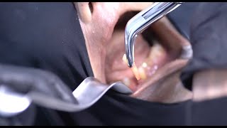 Exodontia por via alveolar transmitido em mais um curso de excelência da Maxillofacialtips [upl. by Anaehr]