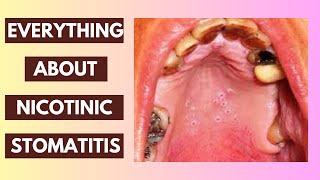 Nicotinic Stomatitis Explained Causes Symptoms and Treatment Options  InDepth Lecture [upl. by Leirvag]