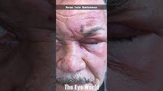 Herpes Zoster Ophthalmicus [upl. by Rather]