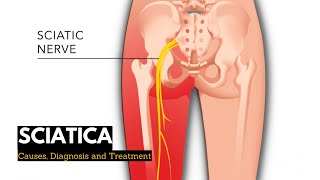 Sciatica Causes Signs and Symptoms Diagnosis and Treatment [upl. by Ydisahc907]