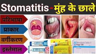 Stomatitis  मुंह के छाले का इलाज  Mouth Ulcer Treatment  Stomatitis In Hindi Muh Ke Chale Ka Ilaj [upl. by Sirromal866]