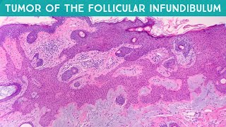 Tumor of the follicular infundibulum TFI  dermpath in 5 minutes dermatology pathology [upl. by Dorsman81]