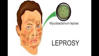 Leprosy Hansens diseaseRidleyJopling classificationclinical features lepra reactiontreatment [upl. by Krenn]