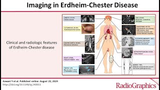 Imaging in ErdheimChester Disease dr Sara NASR [upl. by Schiff]