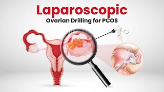 Laparoscopic Ovarian Drilling for PCOS  What is it Can Ovarian Drilling cure PCOS [upl. by Neilson459]