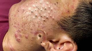 Big Cystic Acne Blackheads Extraction Blackheads amp Milia Whiteheads Removal Pimple Popping 0287 [upl. by Anerul618]