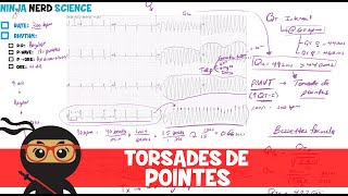 Rate and Rhythm  Torsades de Pointes [upl. by Atokad]