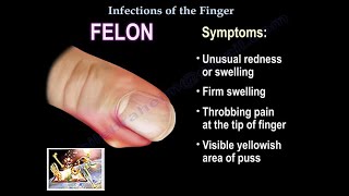 Infections Of The Finger  Everything You Need To Know  Dr Nabil Ebraheim [upl. by Stanwin354]